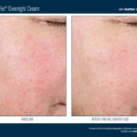 Skinbetter AlphaRet Overnight Cream Before and After 3