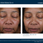 Skinbetter Mystro Active Balance Serum Before and After 1