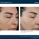 Skinbetter Mystro Active Balance Serum Before and After 2