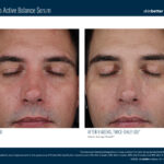 Skinbetter Mystro Active Balance Serum Before and After 3