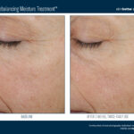 Skinbetter Trio Rebalancing Moisture Treatment Before and After 1