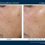 Skinbetter Trio Rebalancing Moisture Treatment Before and After 2