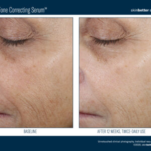 Skinbetter Even Tone Correcting Serum Before and After 1