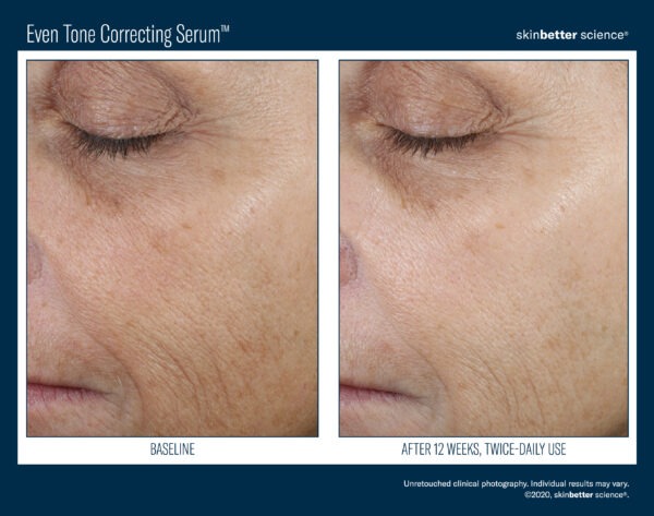 Skinbetter Even Tone Correcting Serum Before and After 1