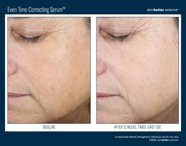 Skinbetter Even Tone Correcting Serum Before and After 3