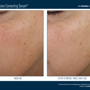 Skinbetter Even Tone Correcting Serum