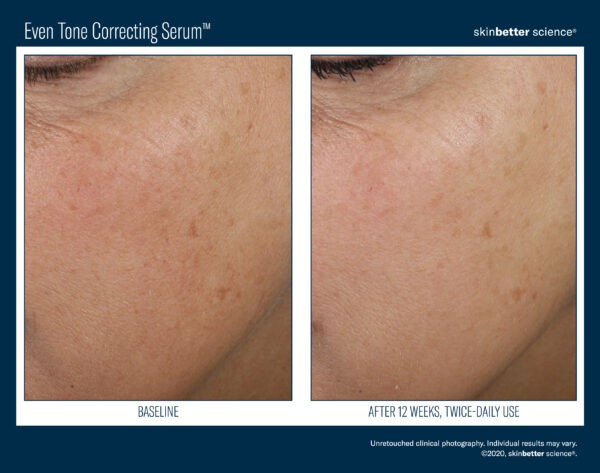 Skinbetter Even Tone Correcting Serum