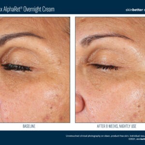 Skinbetter EyeMax AlphaRet Overnight Cream Before and After 1