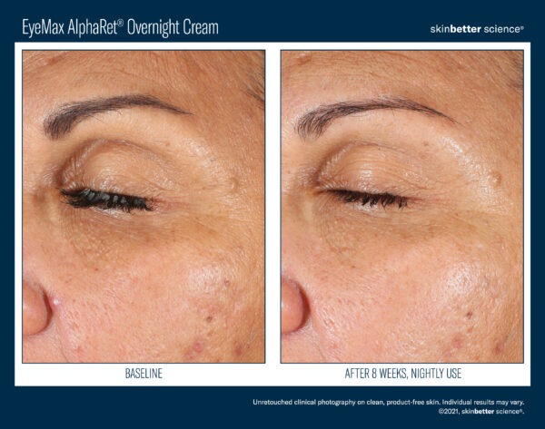 Skinbetter EyeMax AlphaRet Overnight Cream Before and After 1