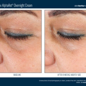 Skinbetter EyeMax AlphaRet Overnight Cream Before and After 2