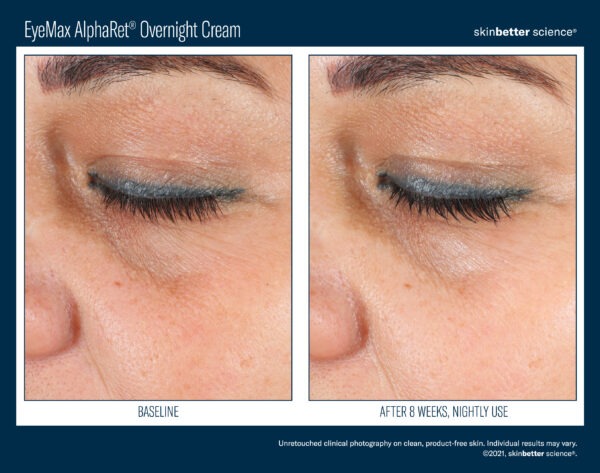 Skinbetter EyeMax AlphaRet Overnight Cream Before and After 2