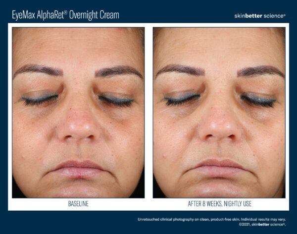 Skinbetter EyeMax AlphaRet Overnight Cream Before and After 3