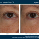 Skinbetter InterFuse Treatment Cream EYE Before and After 1